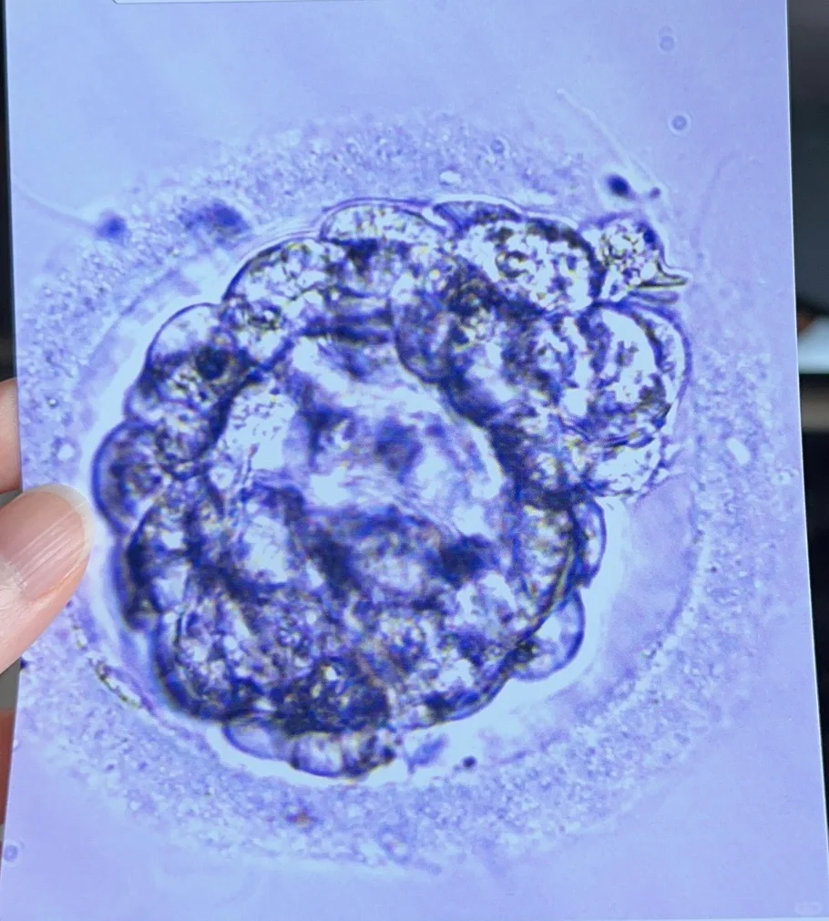 宫颈腺癌术后｜三代试管5AB囊胚移植日 （3）,国内专业代怀收费-国内助孕机构介绍